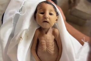 شهادت نوزاد فلسطینی بر اثر سوءتغذیه شدید
