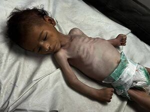 هشدار یونیسف درباره سوء تغذیه شدید ۱۳ هزار کودک در غزه