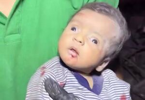 آسیب عجیب نوزاد فلسطینی در اثر حمله صهیونیست‌ها