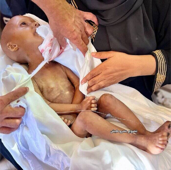 غزه در آستانه فروپاشی کامل نظام سلامت