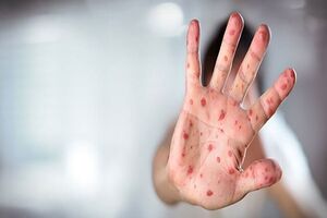 خطر نهضت ضد واکسن و بازگشت بیماریهای واگیر