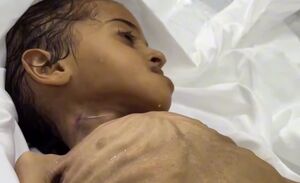 شهادت کودک ۵ ساله فلسطینی بر اثر گرسنگی در غزه