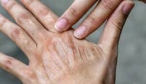 چگونه از خشکی پوست در پاییز جلوگیری کنیم؟