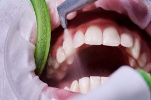 ضرورت سلامت دهان و پیشگیری از بیماریهای لثهای