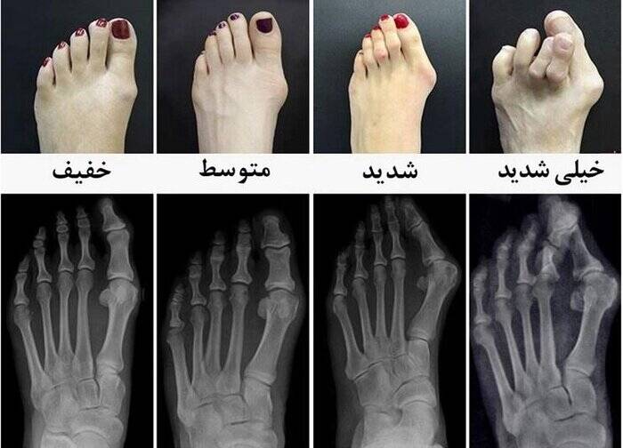 راهکارهایی ساده برای اصلاح انگشتان پا 3