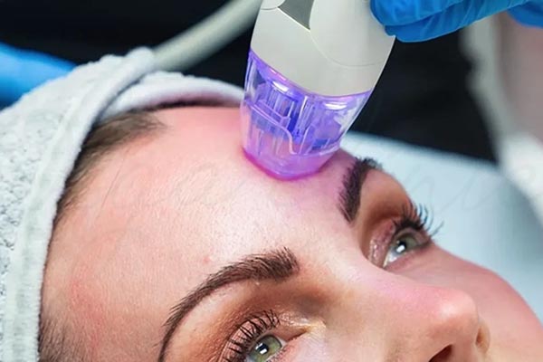 مقایسه و تفاوت های لیزر و آر اف فرکشنال + کدام بهتر است؟