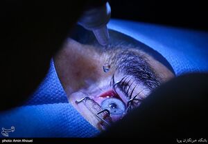 شیوع قوز قرنیه در ایران بالاتر از جهان