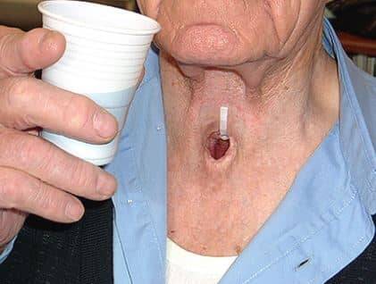 سرطان حنجره از تشخیص تا درمان > دکتر اصلان احمدی متخصص جراحی گوش و حلق و  بینی ، فلوشیپ فوق تخصصی حنجره