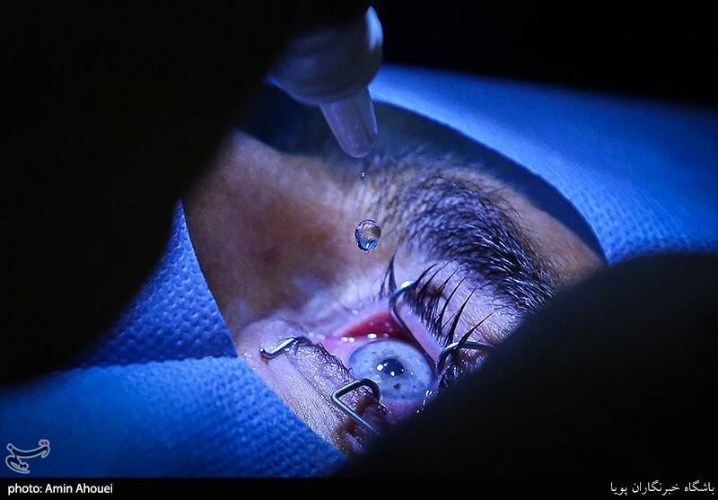 قرنيه،قوز،عوامل،چشمي،محيطي،عج،شيوع،پيشرفت،بيماري