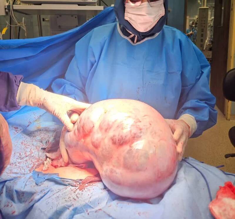 خارج کردن توده ۱۰ کیلویی از شکم یک بیمار در کرج +عکس