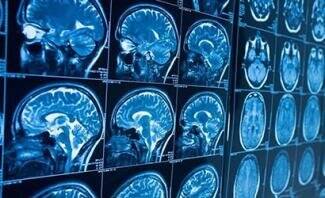 روشی در توقف بیماری آلزایمر کشف شد 2