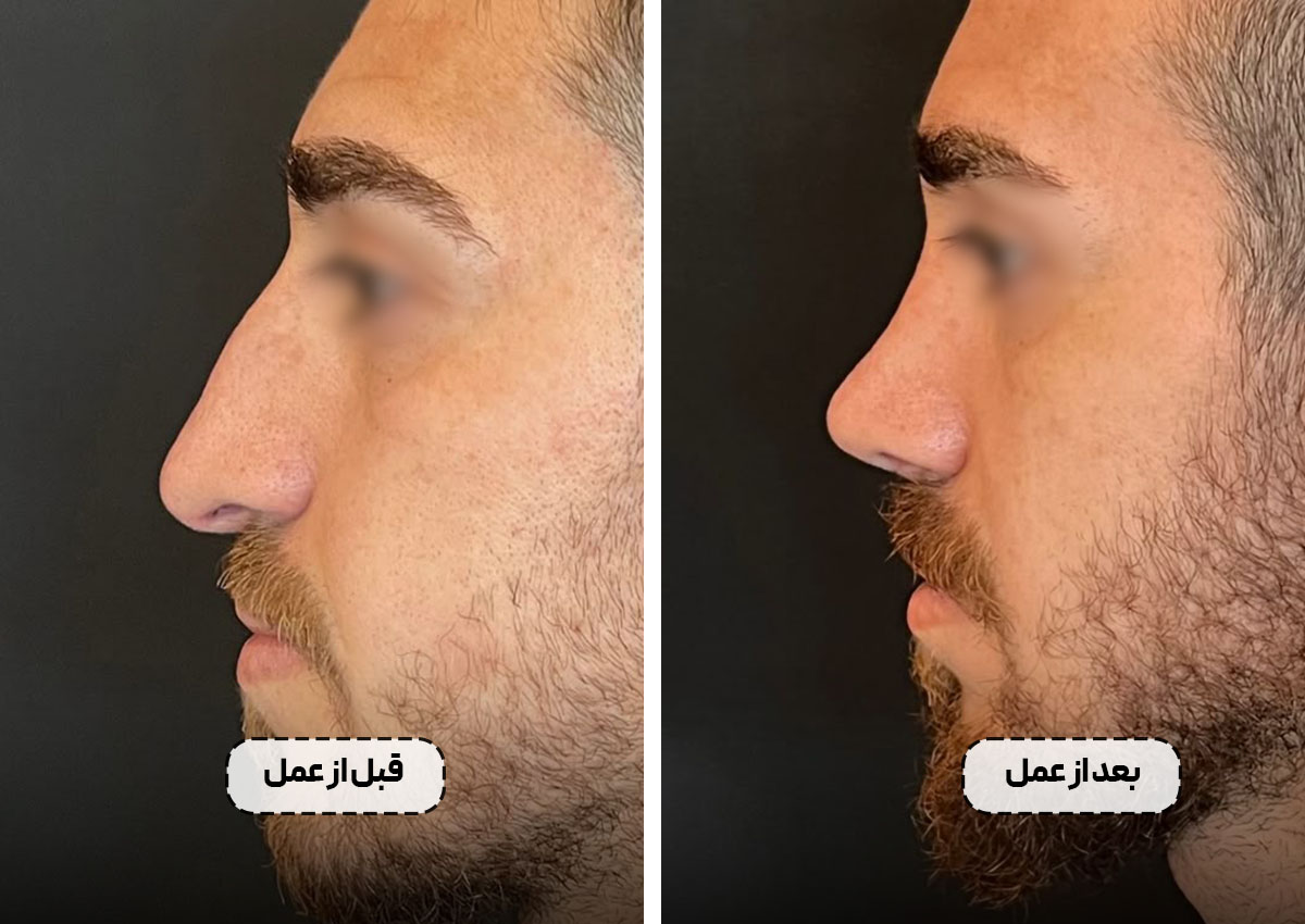 جراحی بینی در تهران با پزشک 24