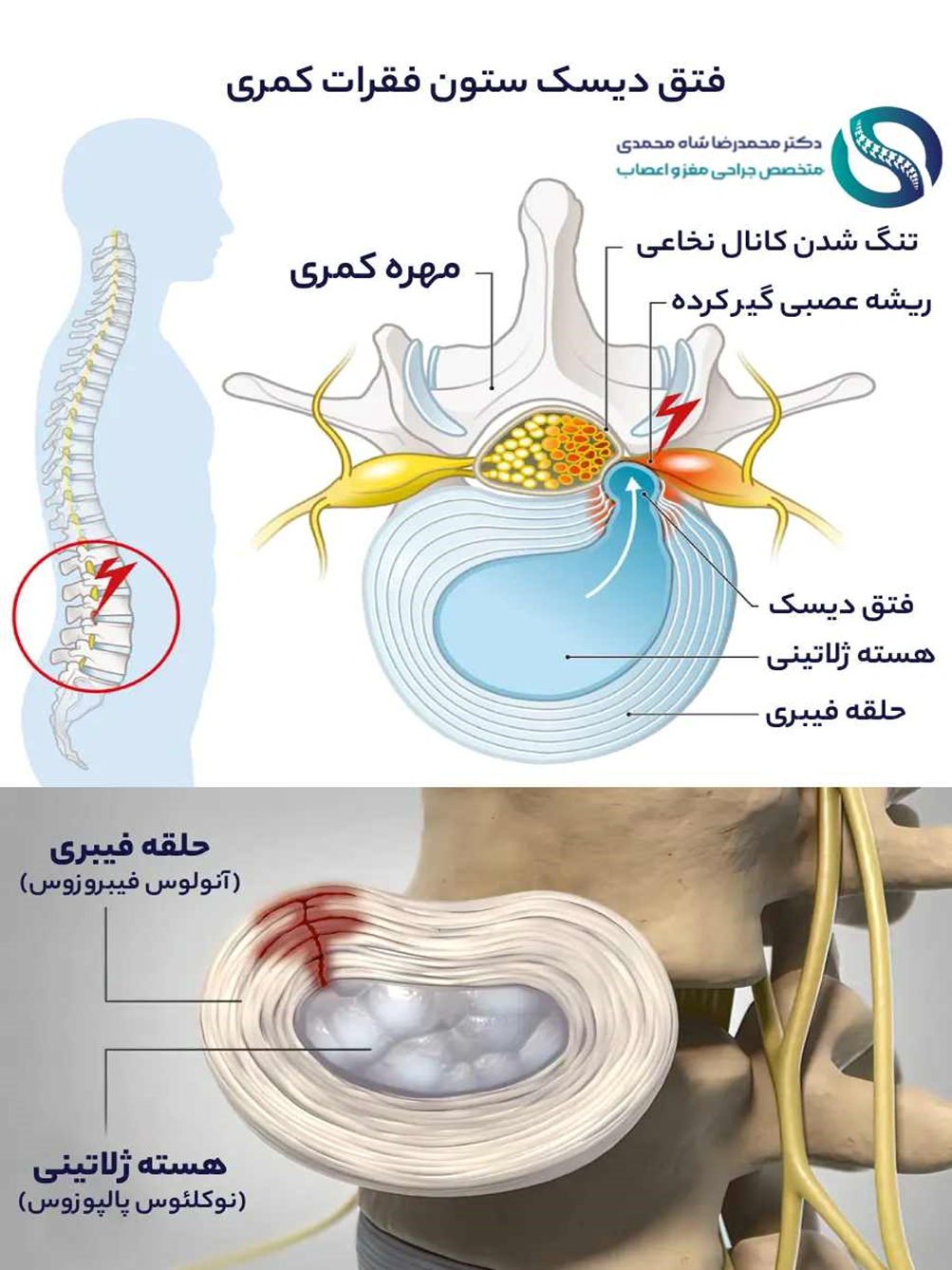 بهترین ورزش و روش خوابیدن برای دیسک کمر و کاهش کمردرد