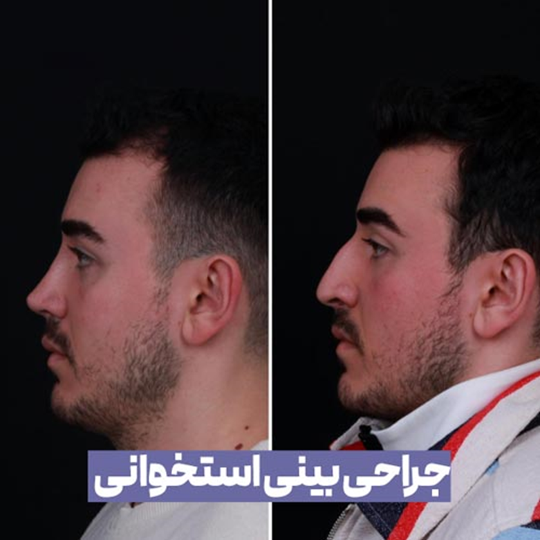 جراحی بینی استخوانی چیست و چقدر هزینه دارد ؟