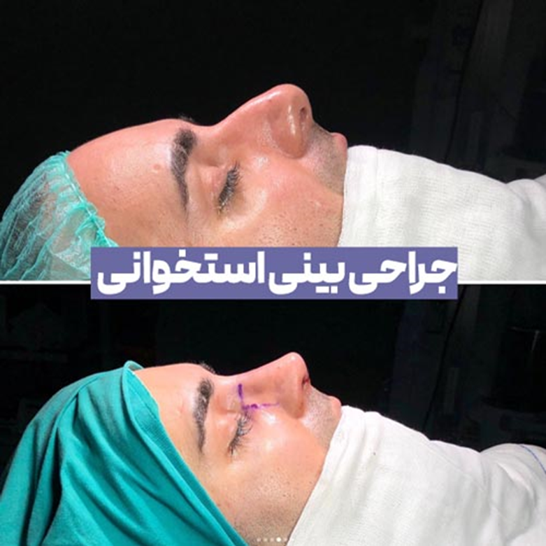 جراحی بینی استخوانی چیست و چقدر هزینه دارد ؟