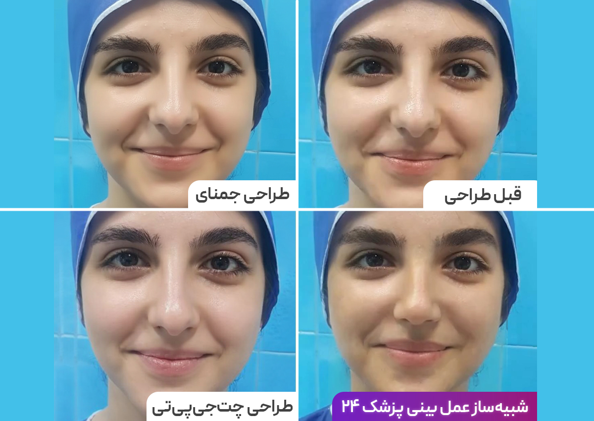 جراحی بینی در اصفهان با پزشک ۲۴