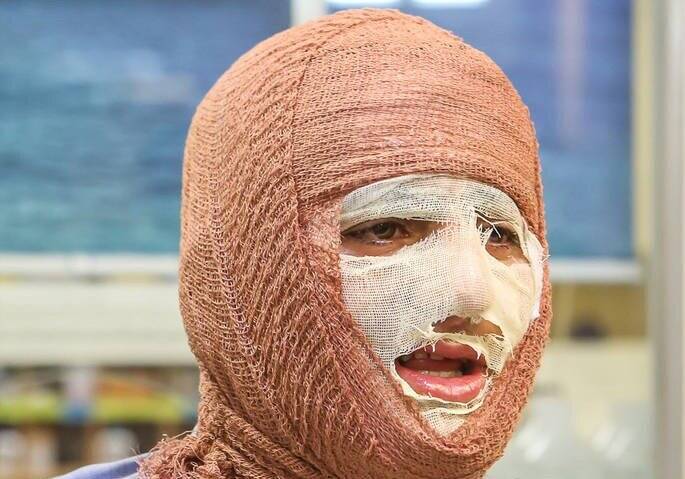 بافت،آخوندي،سوختگي،نسب،مزمن،پوست،بيمار،پلاستيك،زخم