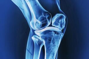 معجزه زردچوبه و زنجبیل برای ایمپلنت استخوان