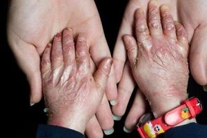 ۲۵ بیماری جدید به فهرست بیماری‌های نادر کشور اضافه شد