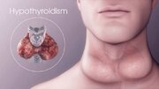 بیماران تیروئیدی به این توصیه توجه کنند