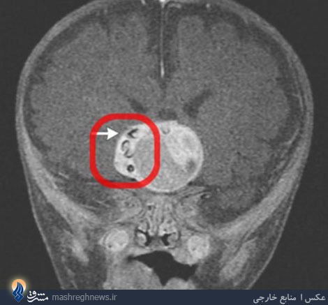 کودکی که در مغزش دندان درآورد+تصاویر