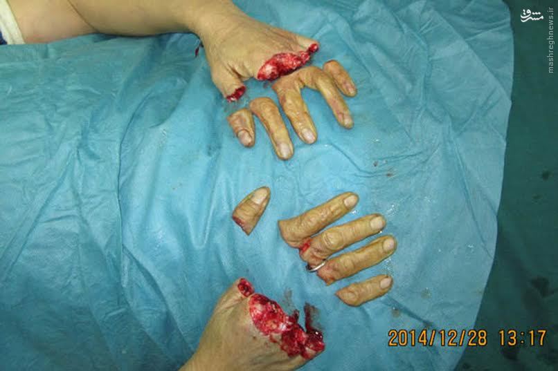 عکس/ قطع شدن انگشتان یک کارگر چینی