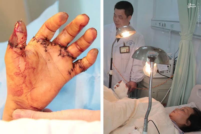 عکس/ قطع شدن انگشتان یک کارگر چینی