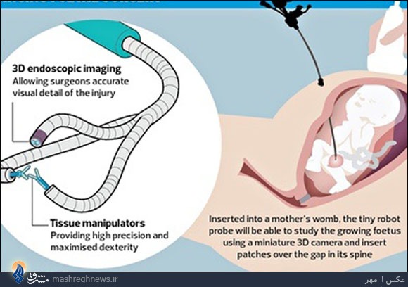 جراحی جنین در سن 6هفتگی+تصاویر