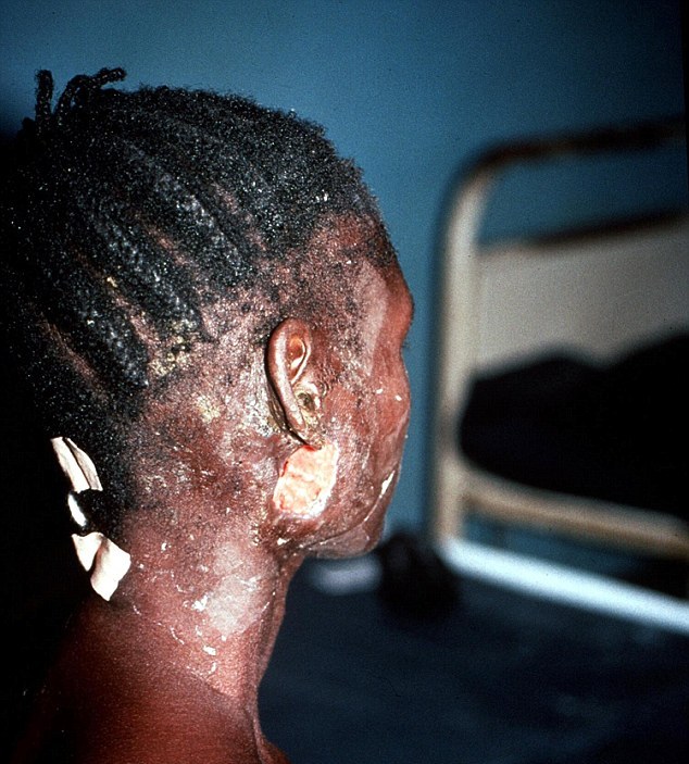 تصاویری ترسناک از مبتلایان به ابولا در افریقا
