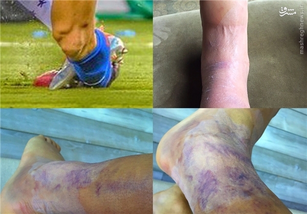 ساق پای سانچز پس از فینال کوپا آمریکا+عکس