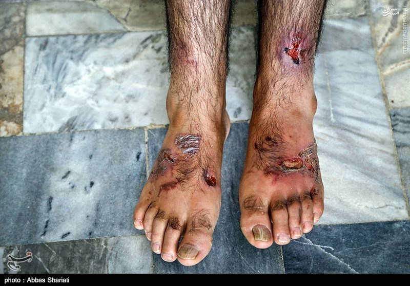 عکس/ پای یک گروگان شکنجه دیده