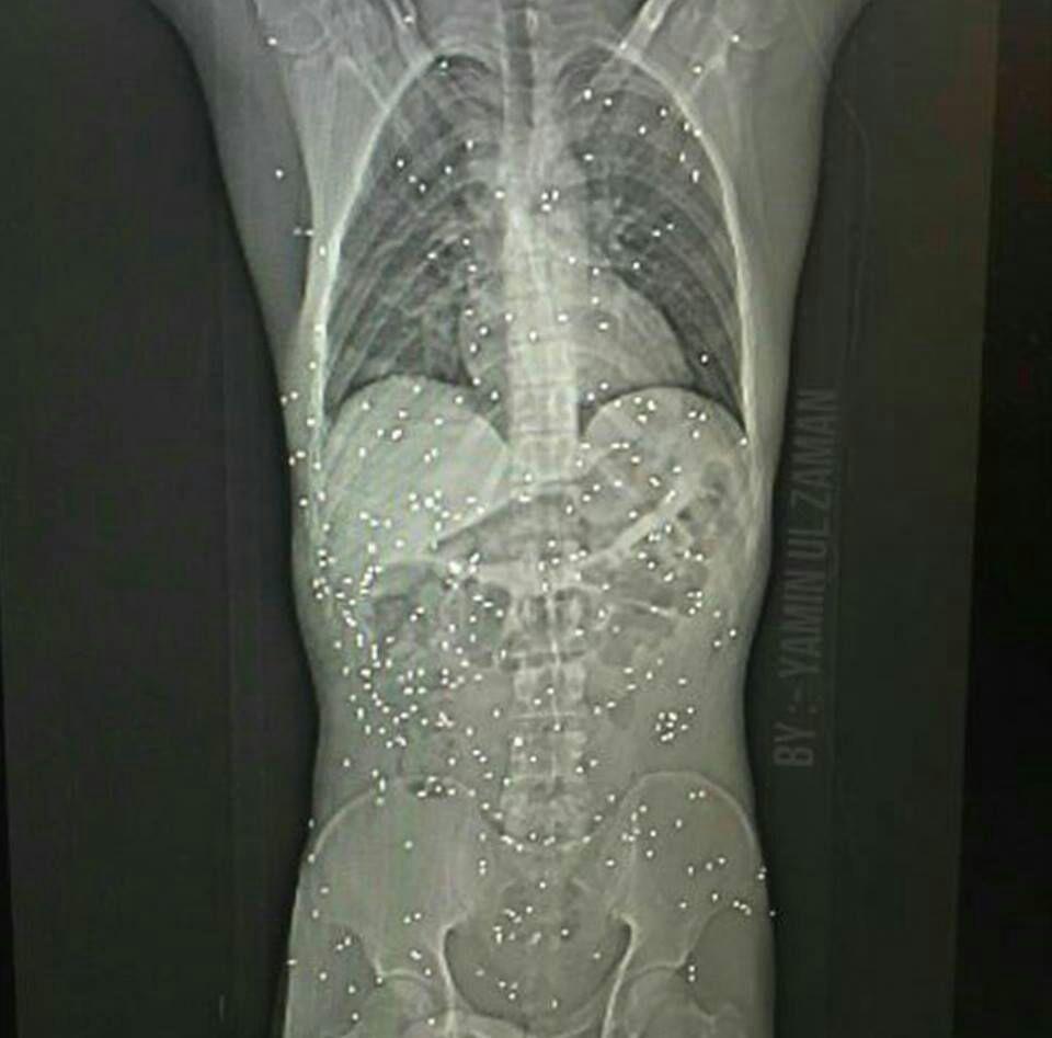 عکس/ تصویر رادیولوژی از گلوله های ساچمه ای در بدن